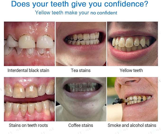 5Pcs Teeth Whitening Pen Gel Kit, Tooth Whitening Essence,Teeth Stain Remover,Intensive Stain Removal Teeth Reduce Yellowing