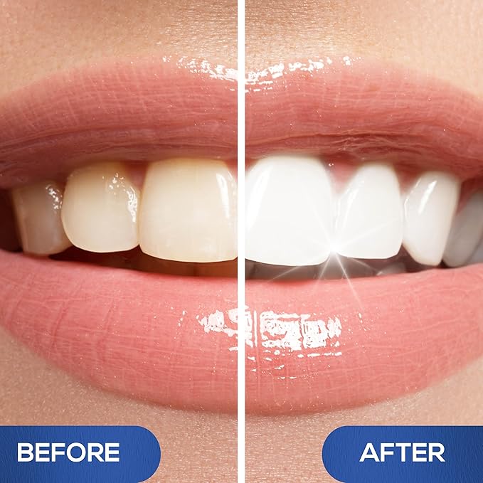 Venus Visage Award Winning Teeth Whitening Pen, 20+ Uses - Teeth whitening Gel Professionally formulated - Best Teeth whitening kit Teeth Whitener - Low Sensitivity (Mint) (0.07 Fl Oz (Pack of 4))